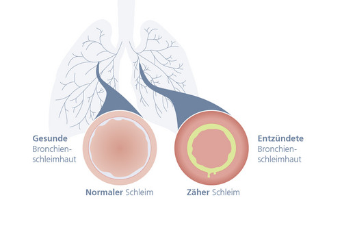 Was sind die Ursachen für Husten mit Auswurf: Gesunde vs. entzündete Bronchialschleimhaut Grafischer Querschnitt der Bronchien, links mit gesunder, rechts mit entzündeter Bronchialschleimhaut