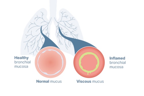 Graphic cross-section of the bronchi, left with healthy, right with inflamed bronchial mucosa