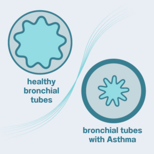 Graphic cross-section of healthy bronchial tubes compared to constricted bronchial tubes in asthma