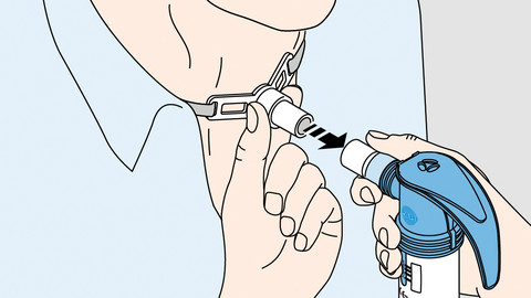 Inhalation with a tracheostomy: Which device for which patient? Schematische Darstellung eines Menschen mit Tracheostoma, der einen Vernebler zur Inhalation mit speziellem Adapter daran anschließt