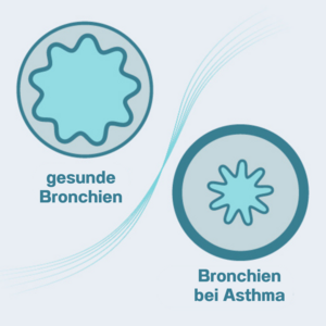 Grafischer Querschnitt gesunder Bronchien gegenüber verengten Bronchien bei Asthma