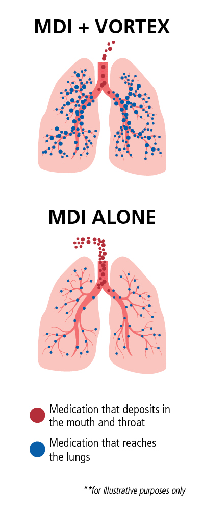 Diagram VORTEX with MDI and alone