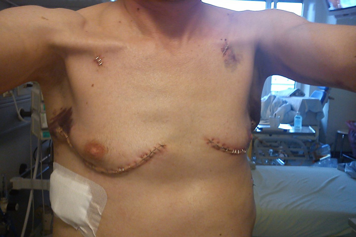 Two weeks after transplantation Two weeks after transplantation